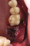 Oxidierte regenerierte Cellulose: Anwendung in der Oralchirurgie - ePaper