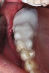 Oxidierte regenerierte Cellulose: Anwendung in der Oralchirurgie - ePaper