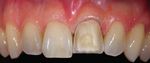 Einzelzahnveneer in der Oberkieferfront - eine Herausforderung - Zahnarztpraxis ...