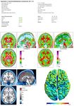 Cortical Thickness Analyse nach olfaktorischem Training bei postinfekti&ouml;ser Dysosmie - Universit&auml;tsklinikum Carl Gustav Carus ...