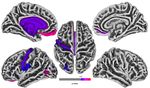 Cortical Thickness Analyse nach olfaktorischem Training bei postinfekti&ouml;ser Dysosmie - Universit&auml;tsklinikum Carl Gustav Carus ...