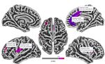 Cortical Thickness Analyse nach olfaktorischem Training bei postinfekti&ouml;ser Dysosmie - Universit&auml;tsklinikum Carl Gustav Carus ...