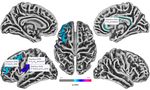 Cortical Thickness Analyse nach olfaktorischem Training bei postinfekti&ouml;ser Dysosmie - Universit&auml;tsklinikum Carl Gustav Carus ...