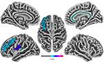 Cortical Thickness Analyse nach olfaktorischem Training bei postinfekti&ouml;ser Dysosmie - Universit&auml;tsklinikum Carl Gustav Carus ...
