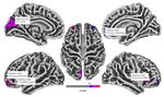 Cortical Thickness Analyse nach olfaktorischem Training bei postinfekti&ouml;ser Dysosmie - Universit&auml;tsklinikum Carl Gustav Carus ...