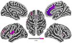 Cortical Thickness Analyse nach olfaktorischem Training bei postinfekti&ouml;ser Dysosmie - Universit&auml;tsklinikum Carl Gustav Carus ...