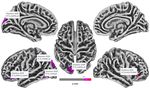 Cortical Thickness Analyse nach olfaktorischem Training bei postinfekti&ouml;ser Dysosmie - Universit&auml;tsklinikum Carl Gustav Carus ...