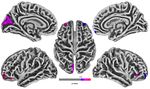Cortical Thickness Analyse nach olfaktorischem Training bei postinfekti&ouml;ser Dysosmie - Universit&auml;tsklinikum Carl Gustav Carus ...