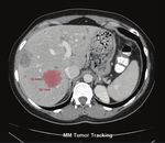 Der Weg zu erfolgreichen Untersuchungen in der onkologischen Diagnostik - Philips