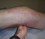 Trotz Knietotalprothese schmerzt das Knie - was nun?