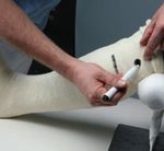 Total Contact Cast: Effektiv in der Behandlung Diabetischer Fußulzera