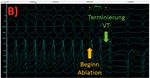 Neu in der Kardiologie - Rhythmologie